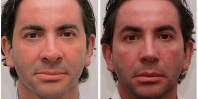 45-54 year old man with Polly Beak Deformity - Bulbous shapeless tip, blockage and snoring - all fixed