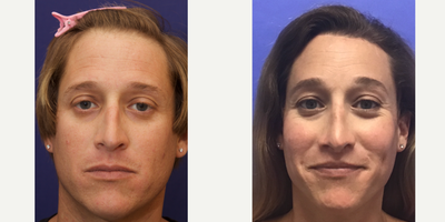 Patient treated with Cheek Augmentation - Cheek Implants - Small Combined - 35 to 44 year-old female patient is 3 years post-op from Facial Feminization surgery. Her procedures included: Forehead Lift, Hairline Lowering, Orbital Bony Contouring, Rhinoplasty (closed) with Weirs and Cartilage Grafts, Cheek Implants - Small Combined, Subnasal Lip Lift with Fat Augmentation and Thyroid Cartilage Shave.