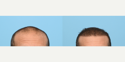 45-54 year old man treated with FUE Hair Transplant, Hair Transplant, PRP for Hair Loss, NeoGraft, Hair Loss Treatment - This patient had an FUE hair transplant with Dr. Wise. To rebuild his hairline and add overall density, 3,050 grafts were used along with a treatment of PRP.