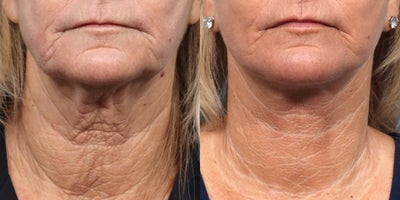 55-64 year old woman treated with Deep Plane Facelift, Facelift, CO2 Laser, Neck Lift - To lift and tighten this patient's lower face and to reverse signs of aging, Dr. Wise performed a deep plane facelift and CO2 laser.