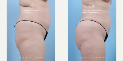 Woman treated with Brazilian Butt Lift - Woman treated with Brazilian Butt Lift