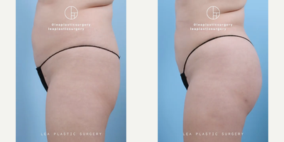 Woman treated with Brazilian Butt Lift - Woman treated with Brazilian Butt Lift