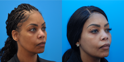45-54 year old woman treated with Dermal Fillers, Chemical Peel, Skin Rejuvenation, Microdermabrasion - Patient is 1 month after undereye filler with Restylane and a series of chemical peels and microneedling.