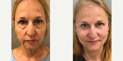 55-64 year old woman treated with Lower Facelift - 60 y/o woman underwent a S-Lift (lower face and neck facelift) and a lower blepharoplasty (lower eyelid) procedure in our office operating suite under sedation.