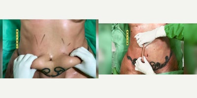 18-24 year old woman treated with BodyTite, Liposuction - 18-24 year old woman treated with BodyTite, Liposuction.