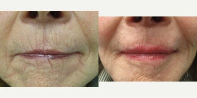 75 and up year old woman treated with Lip Surgery, Lip Fillers - 76-year-old female before and 3 months after a lip lift. Patient was tired of the extremely deep wrinkles as well as thin upper lip. Noticed that dramatic improvement in volume. Patient also had a deep microneedling session to further stimulate collagen production. When the patient is six months after surgery, she can get micropigmentation or cosmetic tattooing to further eliminate the white thin line and help it blend/camouflage better. She has been covering up her scar with lipstick without issue.