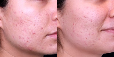 25-34 year old Female underwent Acne treatment - This patient presented for acne treatment. Following a series of photo dynamic therapy treatments, once active acne was the patient was treated with a series of fraxel 1550nm laser treatments to improve acne scars.