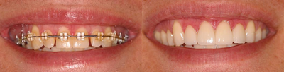 Veneers and teeth whitening - Male aged 26.&nbsp; After having orthodontic treatment to correct his bite, our patient wanted to have the gaps between his teeth closed and wanted a more uniform, brighter smile.&nbsp; We whitened his teeth with our AcquaBrite in-office whitening system, then did 4 conservative, minimal prep DURAthin porcelain veneers (like Lumineers).&nbsp;