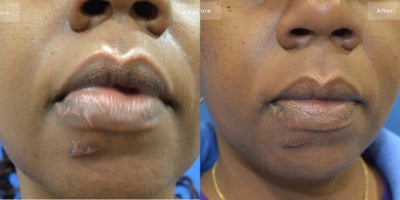 Woman treated with Scar Removal - Scar Revision