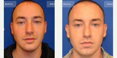 Man treated with Facial Reconstructive Surgery - Facial Skeletal Surgery