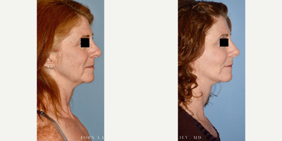 55-64 year old woman treated with Facelift - Facelift, neck lift, facial fat transfer.