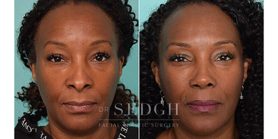 45-54 year old woman treated with African American Rhinoplasty, Rhinoplasty - People of every origin and heritage can expect a solid improvement of definition and refinement with the right technique, and an individulized approach. Only 6 months post rhinoplasty, Dr. Sedgh was able to work with this patient to sculpt her nose to her desired result.