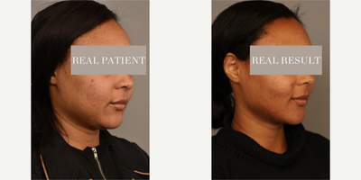 Woman treated with Buccal Fat Removal - Woman treated with Chin/Neck Liposuction, Cheek Liposuction, and Buccal Fat Removal to reduce the roundness of her face while still maintaining a natural look, shown 3 months post op.