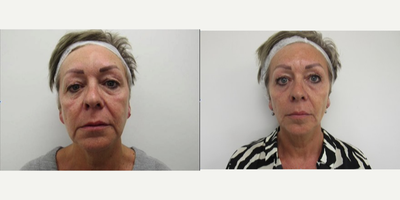 55-64 year old woman treated with Silhouette Soft - Before and after silhouette soft thread lift (photos taken 2 weeks apart)
