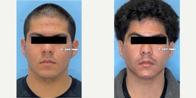 18-24 year old man treated with Extended Chin Liposuction, Facial Masculinization with Fillers ( Chin Fillers, Jaw Fillers ) - 18-24 year old man treated with Extended Chin Liposuction, Facial Masculinization with Fillers ( Chin Fillers, Jaw Fillers )