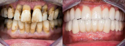 Man treated with Dental Implants - Man treated with Dental Implants
