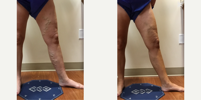 35-44 year old woman treated with EVLT, Sclerotherapy - Patient had an EVLT on greater saphenous vein, followed up with 3 sclerotherapy treatments.