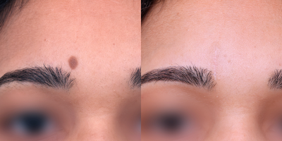 18-24 year old woman treated with Mole Removal - Take a look at these amazing results. This patient underwent mole removal via Excision with Dr. Khorasani. For more information, please visit Dr. Khorasani's website at: https://www.drkhorasani.com/before-and-after-gallery/cosmetic-mole-removal