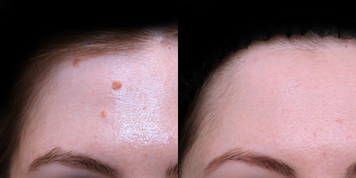 25-34 year old woman treated with Mole Removal via CO2 PreciseFX Ablative Laser - Take a look at these amazing results. For more information, please visit Dr. Khorasani's website at: https://www.drkhorasani.com/before-and-after-gallery/cosmetic-mole-removal