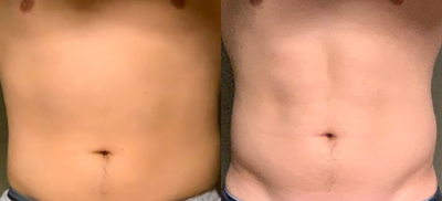 18-24 year old man treated with truSculpt flex - Trusculpt Flex after 4 sessions flex and 3 month break