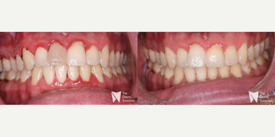 25-34 year old man treated with Internal Tooth Bleaching - 25-34 year old man treated with Internal Tooth Bleaching through internal bleaching for over three visits. Patient presented with a grey tooth.He had gone to a dentist who had recommended a crown.