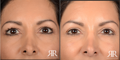45-54 year old woman treated with Eyelid Surgery - Upper Blepharoplasty