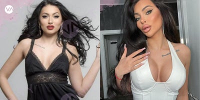 25-34 year old woman treated with Breast Augmentation - 25-34 year old woman treated with Breast Augmentation