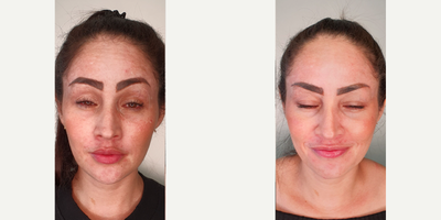 25-34 year old woman treated with Botox - Patient treated with Botox