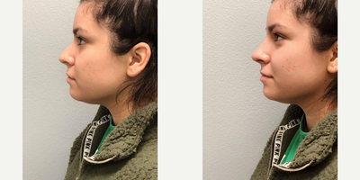Woman treated with Nonsurgical Nose Job, Juvederm, Restylane - Woman treated with Nonsurgical Nose Job, Juvederm, Restylane