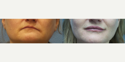 Woman treated with Juvederm, Lip Fillers - Woman treated with Juvederm, Lip Fillers