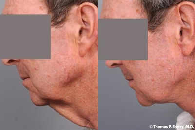 66 year old man treated with Neck Lift - 66 year old man treated with Neck Lift