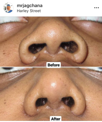 Natural Ethnic Rhinoplasty Afro Review Realself