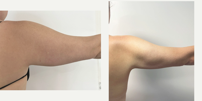 35-44 year old woman treated with Vaser Liposuction - Before and after images illustrating the effects of VASER Liposuction on the upper arms, showcasing the slimming and contouring achieved through this targeted procedure.