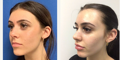 18-24 year old woman treated with Cheek Augmentation, Lip Fillers, RHA Collection Fillers - RHA 4 placed to Cheeks, RHA 3 placed to Lips