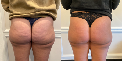 25-34 year old woman treated with Qwo - 2 treatments in the buttocks