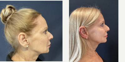 55-64 year old woman treated with Restylane Lyft - Restylane lyft placed to Jawline, Cheeks, and Nasolabial folds.