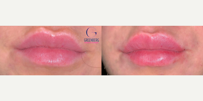 Woman treated with Juvederm - Woman treated with Juvederm to add more volume and definition to the lips as well as improve the symmetry in the vermillion border