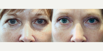 46 year old woman treated with Upper Blepharoplasty Surgery - 46 year old woman treated with Upper Blepharoplasty Surgery, correcting droopy eyelids and giving the fave a more youthful appearance.