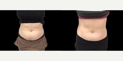 Woman treated with CoolTone - Woman treated with CoolTone.