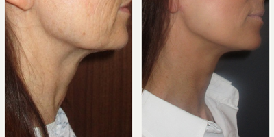 55-64 year old woman treated with Neck Lift - Additionally to her neck lift we treated her cheek area with my trademarked 'centennial lift' procedure to soften her longitudinal fine lines and wrinkles.