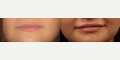 25-34 year old woman treated with Lip Augmentation - Patient was injected 1 ml of Juvederm lip fillers in her upper lip. Created more volume towards the sides of her upper lip (Dr. Kremer- lip). Changed the expression of her face to a very friendly and sweet feminine look.