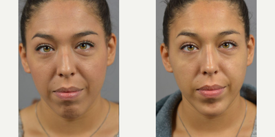 Woman treated with Nonsurgical Nose Job, Botox, Dermal Fillers - Facial Asymmetry and contour is natural and makes each face unique. While most imperfections go unnoticed by the outside world. Often times we treat with surgical interventions but for a temporary adjustment with just as much impact the use of Botox and Filler can be used. Non-surgical Rhinoplasty by Dr. James Marotta complimented by filler injections to the chin.