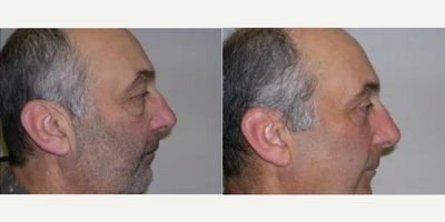 Man treated with Eyelid Surgery - Man treated with Eyelid Surgery.