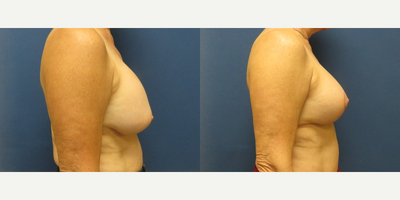 65-74 year old woman treated with Breast Implant Revision - Patient had capsular contracture and some mild breast ptosis over 20 years after original breast augmentation with 230cc silicone implants. Wanted to stay similar in volume but achieve lift and softening. Bilateral lift and removal of capsules was performed. 250cc moderate profile silicone implants placed. This displays early and red scarring which will fade with time.