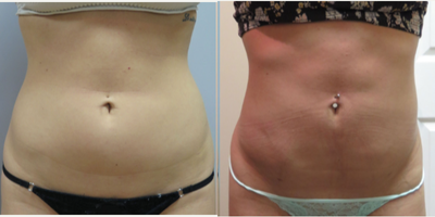 35-44 year old woman treated with Laser Liposuction - Power assisted liposuction. When performing large volume liposuction, we use laser, ultrasound and/or radiofrequency energy to achieve skin tightening so that you are not left with loose hanging skin. For larger volume removal we may need to perform two stages for maximal fat removal.