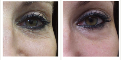 45-54 year old woman treated with Exilis - 4 sessions exilis for lines and crepiness around eyes. Painless experience, with no downtime.