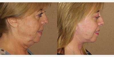 Woman treated with Facelift - Woman treated with Facelift