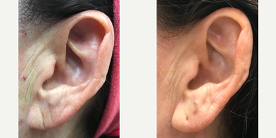 35-44 year old woman treated with Earlobe Repair, Juvederm - Juvederm injected in the earlobe.