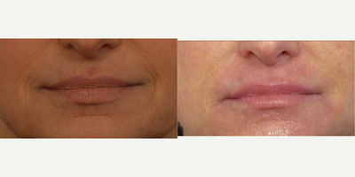 Fine lines treated with Profound RF and Fraxel Repair - Fine lines around the mouth treated with Profound RF and Fraxel Repair