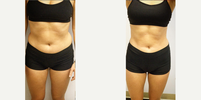 25-34 year old woman treated with Emsculpt - Emsculpt treatment after 4 weeks